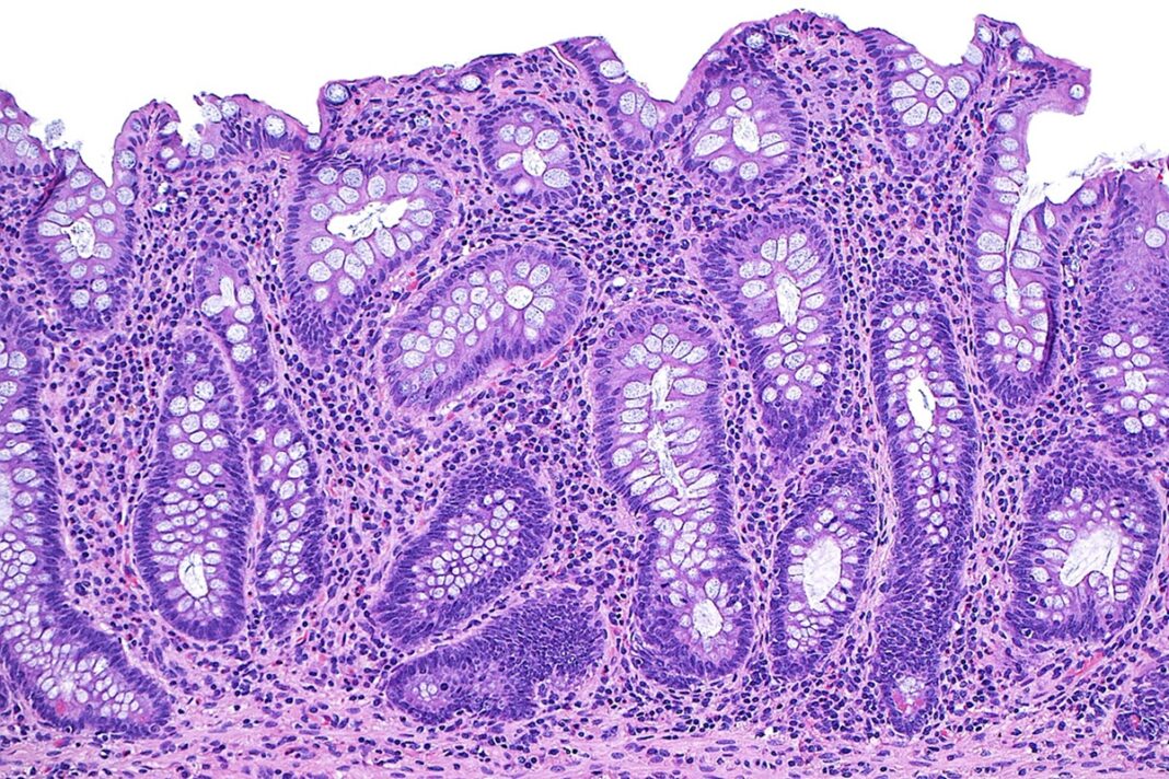 doenca-inflamatoria-intestinal.jpg