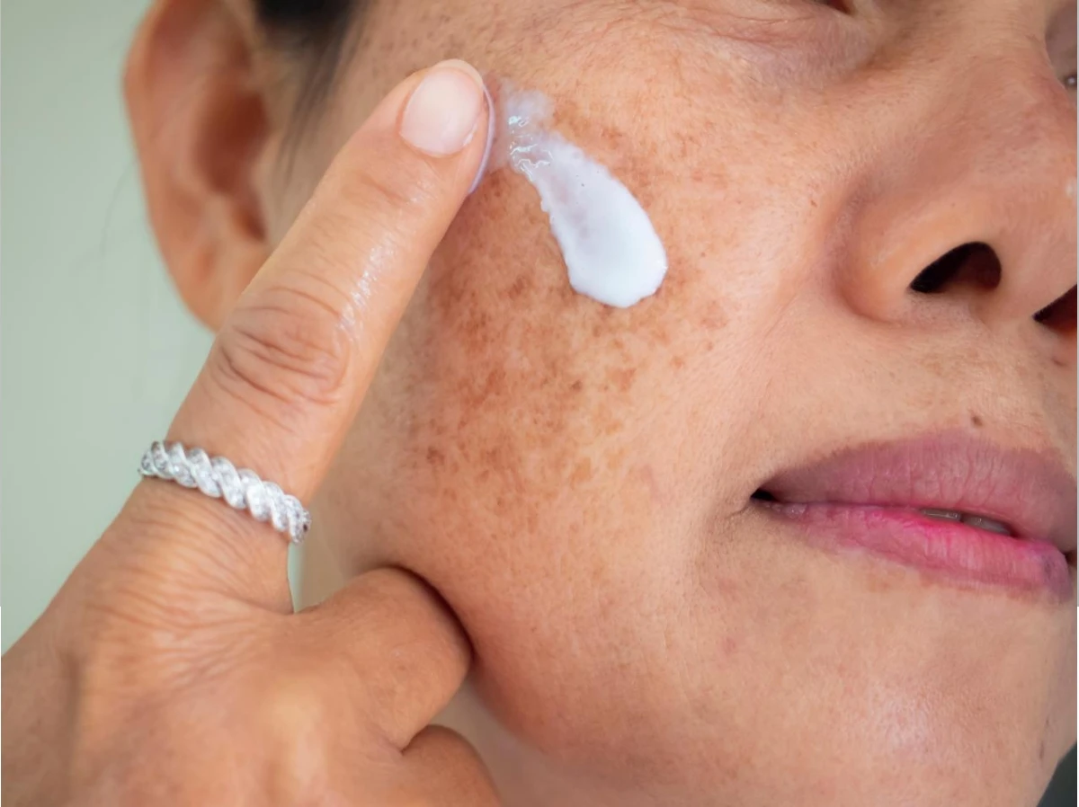 Melasma tem cura? Veja o que realmente funciona no tratamento