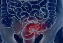 Rastreamento para câncer colorretal pode ser implementado no SUS