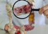 Em 13 anos, doença inflamatória intestinal cresce 5 vezes no Brasil