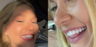 Joia nos dentes: dentista alerta sobre risco de tendência entre influencers