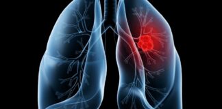 Saiba o que é adenocarcinoma pulmonar, câncer que atinge o Papa Leão XIV